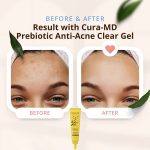 ⁦CURA-MD Prebiotic Anti-Acne Clear Gel 8 ml⁩ - الصورة ⁦6⁩