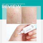 ⁦PrimaNest Birdnest Acne Clear On Spot Treatment Gel 10g⁩ - الصورة ⁦3⁩